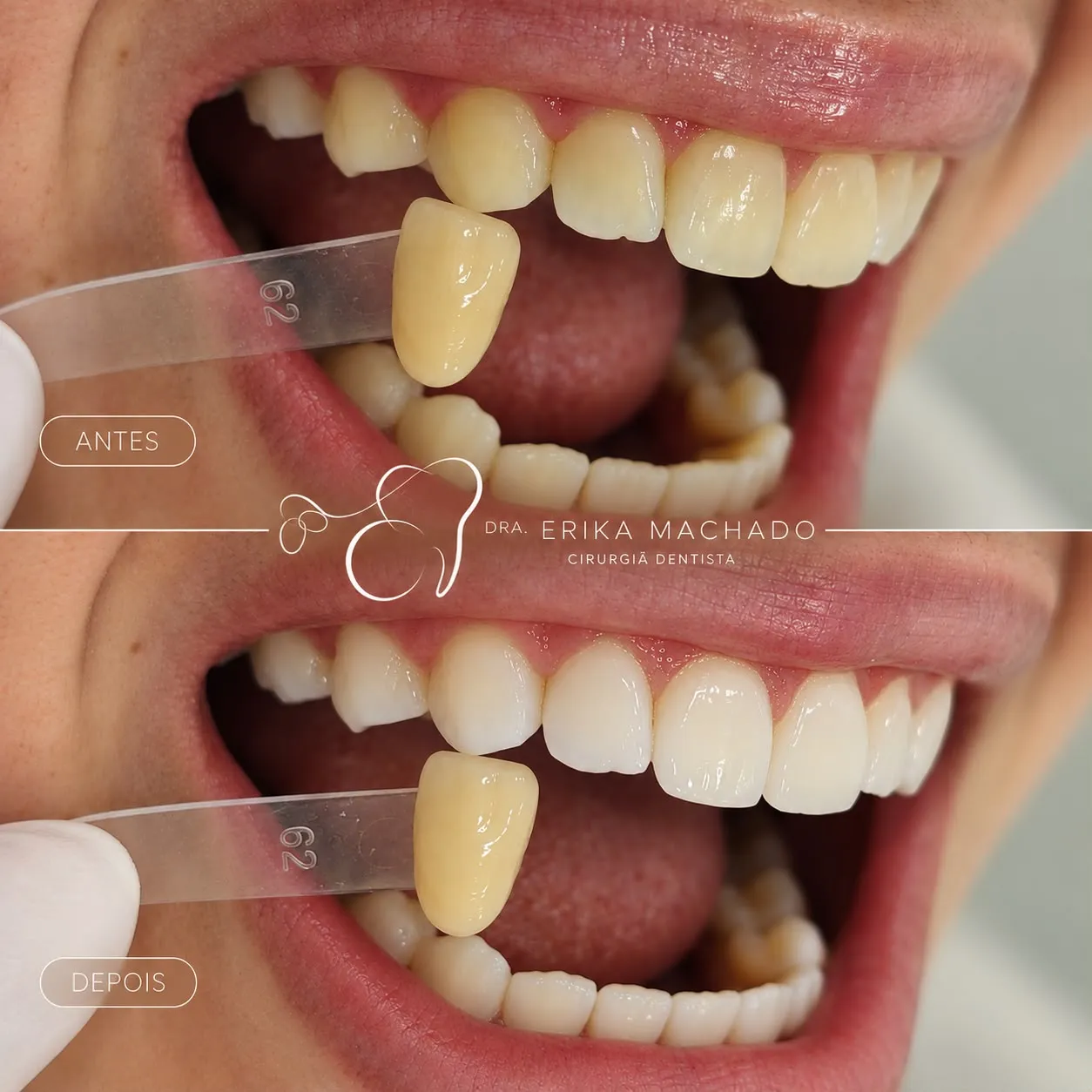 Clareamento Dental