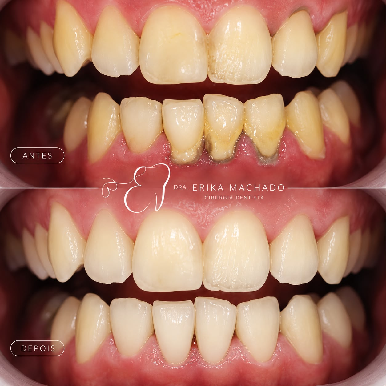 Limpeza Dental e Prevenção - Dra. Erika Machado