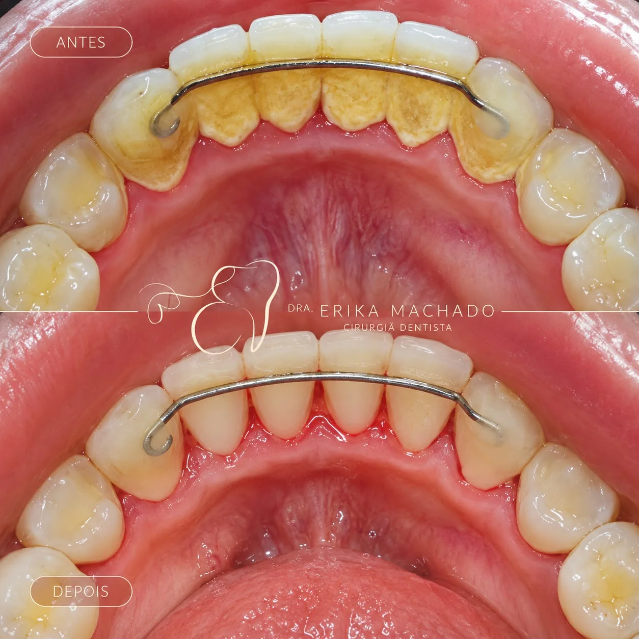 Limpeza Dental - Dra. Erika Machado