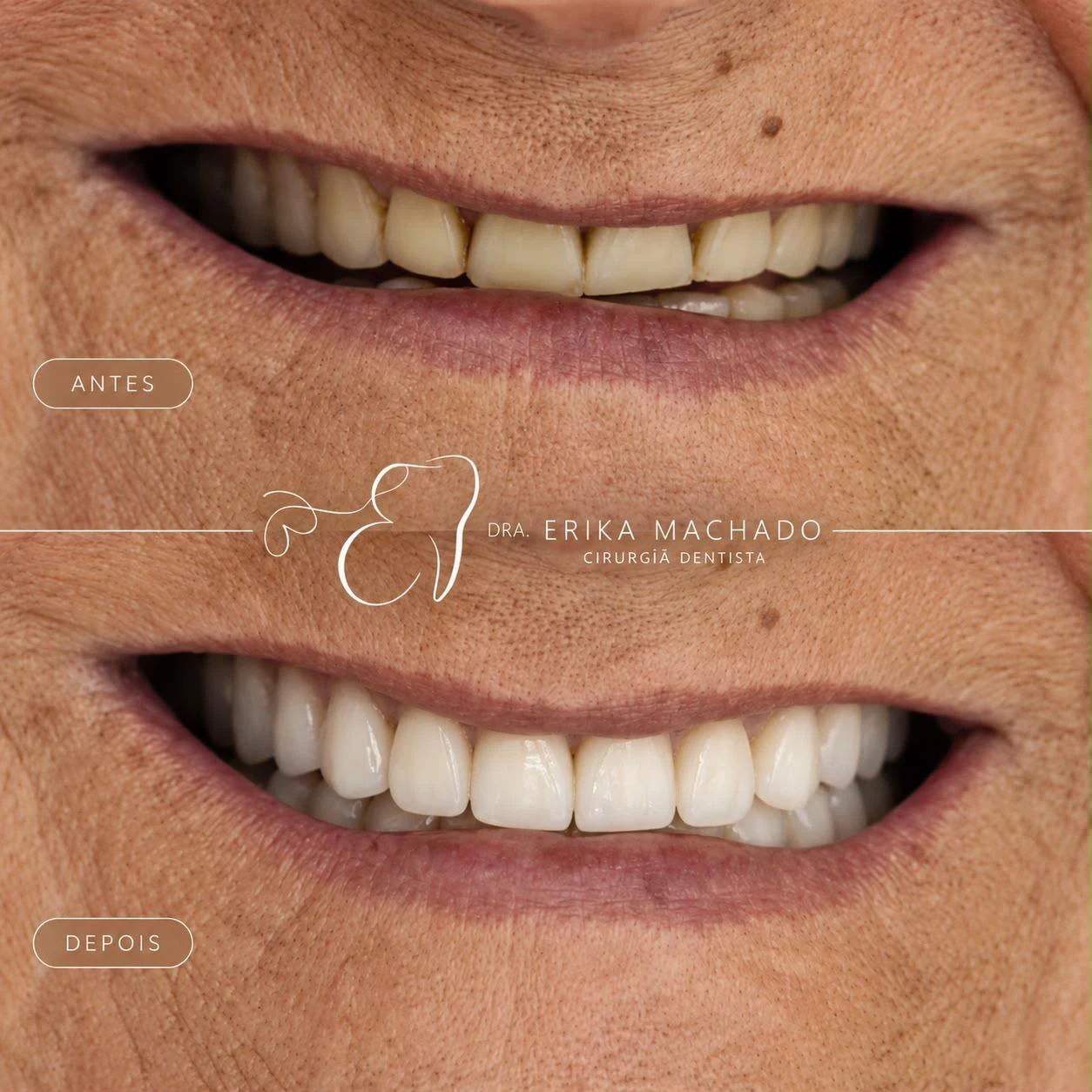 Prótese Dentária - Dra. Erika Machado