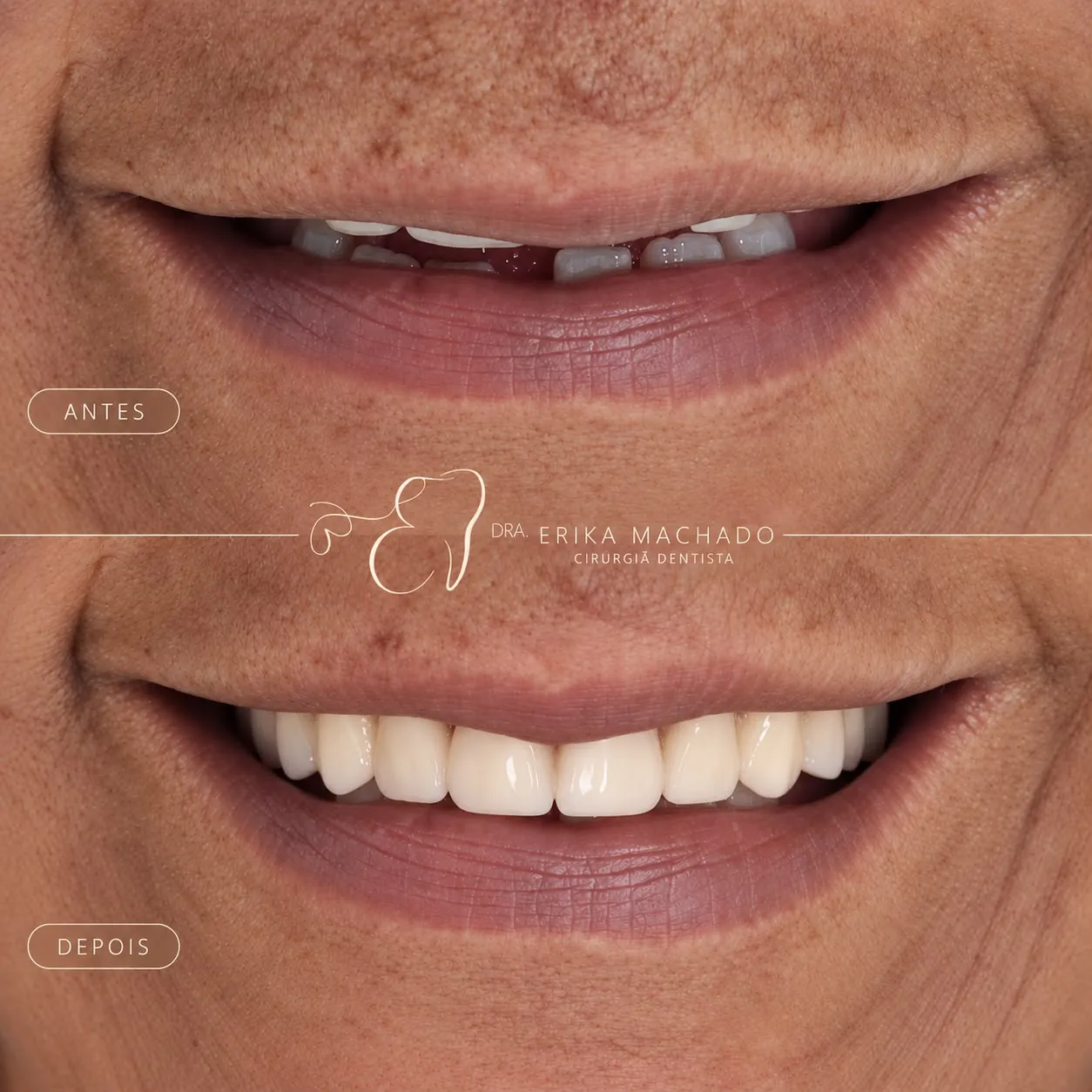 Prótese Dentária - Dra. Erika Machado