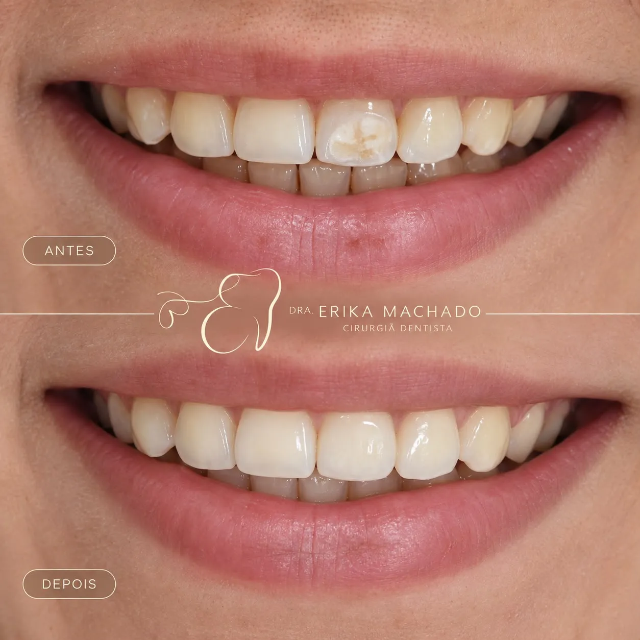 Restauração Estética em Resina