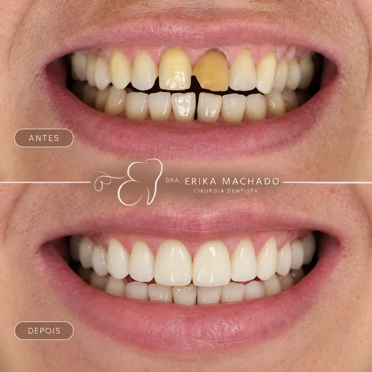 Restauração com Resina - Dra. Erika Machado